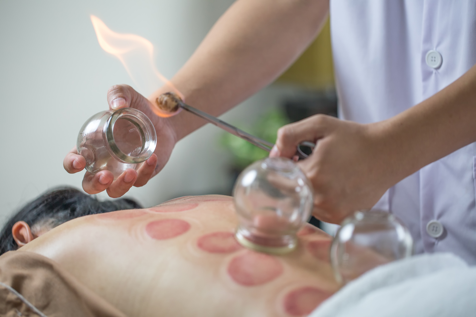 Cupping your way to beauty: It’s a trendy treatment in Hollywood, but does it work?