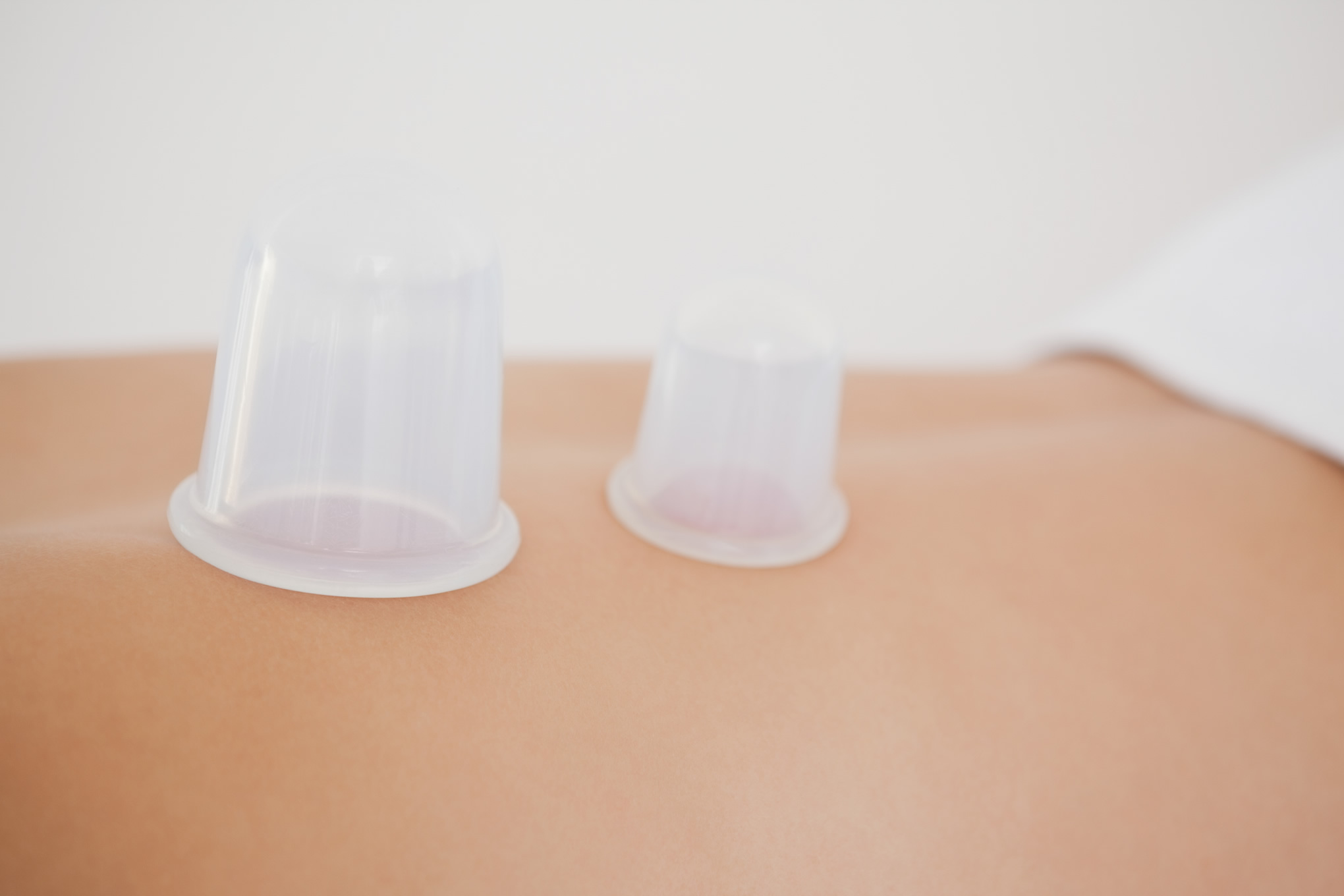 Everything You Need to Know About Cupping Therapy